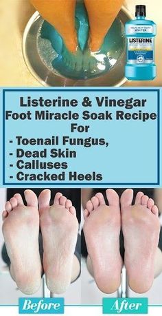 Listerine & Vinegar Foot Miracle Soak Recipe for Toenail Fungus, Dead Skin, Calluses & Cracked Heel Listerine Foot Soak, Foot Soak Recipe, Beauty Remedies, Skin Care Remedies, Foot Care, Health And Beauty Tips, Beauty Treatments