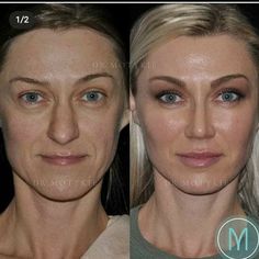 Jaw Reduction Surgery, Plastic Surgery Fail, Plastic Surgery Gone Wrong, Rhinoplasty Before And After, Aesthetic Dermatology, Botox Cosmetic