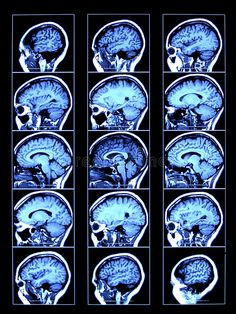 mri images of the human brain