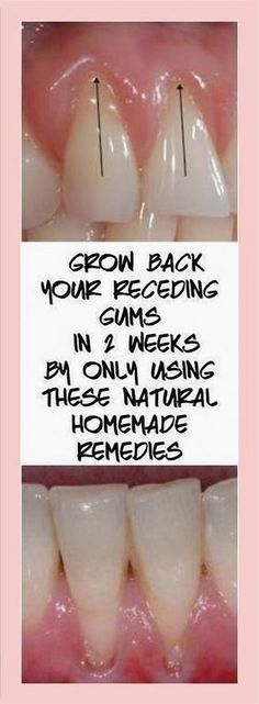 Revitalize your gum health with these effective natural remedies designed to help restore receding gums. Grow Back Receding Gums, Teeth Health, Receding Gums, Gum Health, Health And Fitness Articles, The Dentist, Oral Health Care, Teeth Care, Homemade Remedies