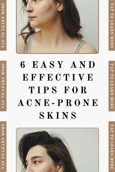 One word, four letters, and instant dread: Acne. At some point in most people's lives -whether it hits you in high school, college or your adult years-, there is always that hunting possibility of getting unwanted skin problems, being acne the most popular one. It can appear all over your face and body. And if Instant Dreads, Chemical Exfoliation, Severe Acne, Cleansing Routine, How To Get Rid Of Acne, How To Treat Acne, One Word, In High School