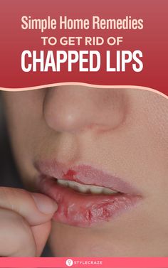 Chapped Lips Remedy, Drink Enough Water, Baby Lips, Cracked Lips, Drink Plenty Of Water, Health Vitamins, Natural Cough Remedies, Braut Make-up, Beauty Regimen