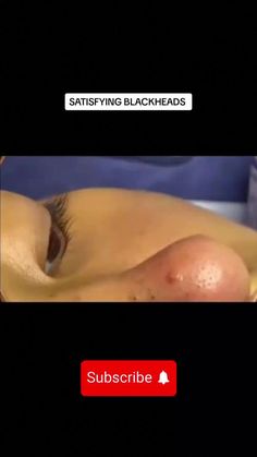 Unlock Clear Skin: Master This One Blackhead Trick #Blackheads #skincare #blackheadremoval #cleanser #facecleanser #beautyhacks #BestNaturalRemedies How To Remove Blackheads, To Remove Blackheads, Remove Blackheads, Get Rid Of Blackheads