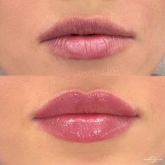 Derma Fillers, Lip Surgery