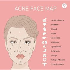 Acne Marks Remedies, Acne Face Map, Face Map, Face Mapping Acne, Beauty Marks, Skin Advice, Face Mapping, Acne Face, Skin Care Routine Order