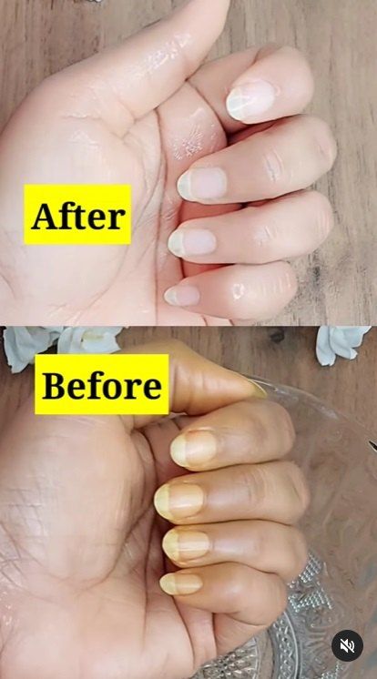 Diy Nail Whitener, How To Get Whiter Nails At Home, How To Get Nails White, How To Clean Yellow Nails, Get Rid Of Yellow Nails, How To Whiten Fingernails, How To Whiten Yellow Nails, How To Whiten Nails Naturally, How To Remove Yellow Stains From Nails