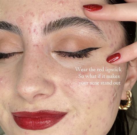 #acnepositivity #redlipstick #rednails #makeuptutorial #selflove #acneisnormal Acne Self Love, Acne Appreciation, Accepting Imperfection, Acne Positive, Acne Aesthetic, Acne Awareness, Acne Positivity, Skin Positivity, Textured Skin