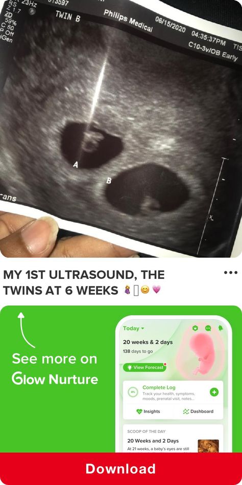 My 1st ultrasound, the twins at 6 weeks 🤰🏽😊💗 -  - See the rest of this post by downloading Glow Nurture - The Top Rated Pregnancy & Baby Bump Tracker! #pregnancy #bump #duedate #pictures #progression #baby 6 Week Ultrasound Pictures, 4 Weeks Pregnant Ultrasound, Ultrasound Prank, Twins Ultrasound, Baby Ultrasound Pictures, 4 Weeks Pregnant, Sonogram Pictures, Pregnancy Ultrasound, 4d Ultrasound