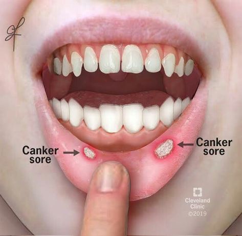 Cold Sore Remedy Fast, Canker Sore Causes, Lips Picture, Canker Sore Relief, Lime Lips, Canker Sore Remedy, Tongue Sores, Dental Facts, Canker Sore