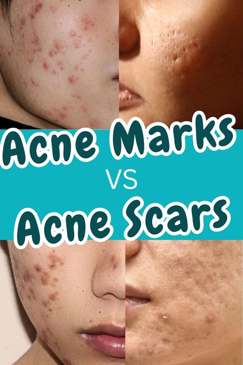 Acne Marks vs Scars: The Ultimate Informational Guide (with Photos) Scar Remedies, Cystic Acne Remedies, Post Acne Marks, Acne Scarring, Types Of Acne, Home Remedies For Acne, Acne Scar Removal, Acne Solutions, Acne Marks