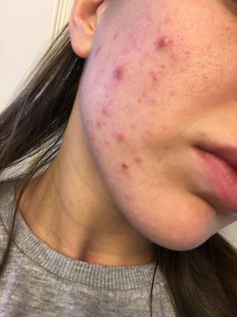 Acne Aesthetic Girl, Girl With Acne Aesthetic, Normalize Acne, Girls With Acne, Acne Positive, Acne Aesthetic, Acne Photos, Acne Pictures, Clear Dark Spots