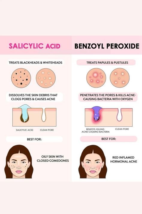 If you have any of this acne in my page i have the right product you need to fight this acne. Cystic Acne Remedies, Forehead Acne, Sephora Skin Care, Natural Acne Remedies, How To Get Rid Of Pimples, Skin Care Order, Glow Skin, Acne Solutions, Hormonal Acne