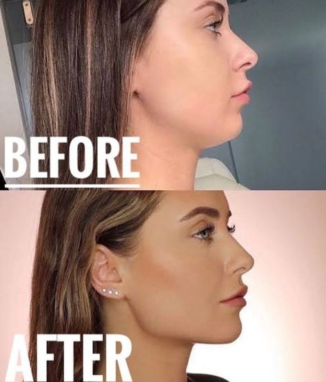 jawline exerciser Face Exercises For Jawline, Best Jawline, Jawline Goals, Chiseled Jaw, Perfect Jawline, Good Jawline, Jaw Exercises, Jawline Exercise, Chiseled Jawline