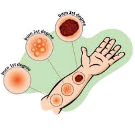 First-degree burns are considered mild compared to other burns. They result in pain and reddening of the epidermis (outer layer of the skin).   Second-degree burns(partial thickness burns) affect the epidermis and the dermis (lower layer of skin). They cause pain, redness, swelling, and blistering.   Third-degree burns (full thickness burns) go through the dermis and affect deeper tissues. They result in white or blackened, charred skin that may be numb. #Fitstaidclassesinpalmdale#Fitstaidclass… Types Of Burns, First Aid For Burns, Degree Burns, First Aid Course, Severe Burns, Cucumber Water, Safety And First Aid, Free Stuff By Mail, Essential Oils For Skin