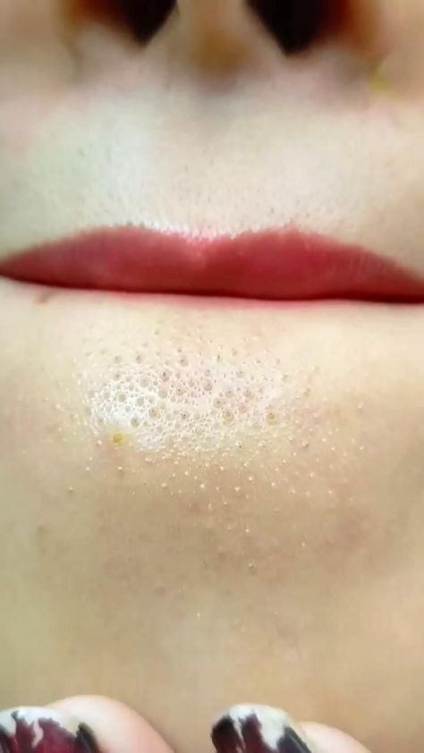 I show you how to treat acne at home Skin Care Routine Face, Beginner Skin Care Routine, Modele Fitness, Skin Care Basics, Face Skin Care Routine, Clear Healthy Skin, Diy Skin Care Routine, Quick Workout Routine, Treat Acne