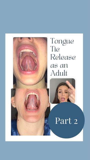 Margaret Barry• FNTP, CPT, PCES on Instagram: "Part 2 of this series, talking about my experience with a tongue release as an adult!❓❓Question: would you have a knee replacement, and skip the rehabilitative therapy before and after the surgery? I hope not!! Likewise, it is important to undergo preparatory measures ahead of and after a tongue tie release. I believe the preparation I did with the rest of my body and tissues (myofunctional therapy, myofascial release, and cranial work) allowed me t Tongue Tie Release, Tongue Tie Exercises, Mewing Before And After, Mewing Tongue Posture, Tongue Exercises, Jawline Exercise, Myofunctional Therapy, Facial Bones, Oral Motor