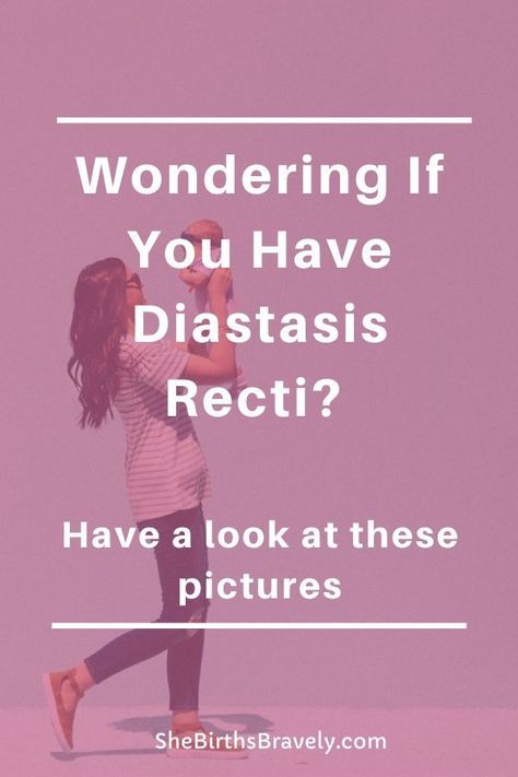 It is possible to heal your Diastasis Recti and lose your Mommy tummy? Need some inspiration? Then have a look at these before and after pictures of women who restored their core by following an exercise program and consistently working out. Click for a visual guide to diastasis recti.  #shebirthsbravely #doula #postpartum #diastasisrecti #mommytummy #fourthtrimester Diastasis Recti Exercises Workouts Videos, Split Abs Diastasis Recti Exercise, Exercise Diastasis Recti, Mommy Pooch Workout Diastasis Recti, Mommy Tummy Before And After, How To Get Rid Of Diastasis Recti, Heal Diastasis Recti Fast, Ab Separation Diastasis Recti, How To Fix Diastasis Recti