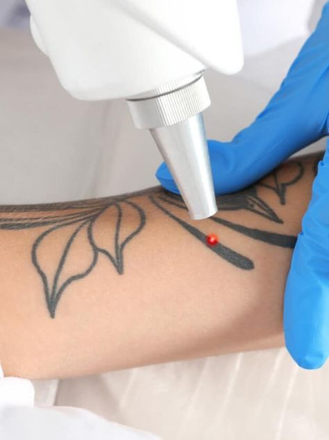 Skin Design Tattoo Removal Tattoo Removal Cream, Tattoo Removal Cost, Tattoo Off, Laser Removal, Laser Hair Removal Machine, Laser Clinics, Hair Removal Machine, Laser Tattoo, About Tattoo