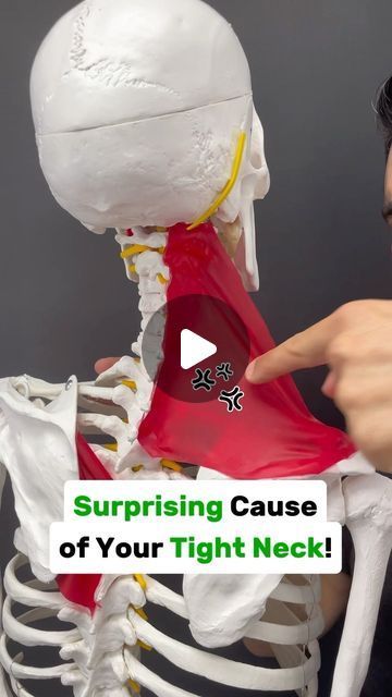 Dr. Joe Damiani - TMJ, Head & Neck Specialist on Instagram: "Comment the word ‘NECK’ on this video if you need help fixing neck or shoulder pain.

Do you experience stifness or pain on one side of your neck? Maybe it moves down to the top of the shoulder, shoulder blade or arm?

Have you also been stretching that tight muscle by pulling in the opposite direction? Maybe you’ve been tight to stretch the upper trapezius or scalene muscles.  This is a very common mistake because while of course there are times when the muscle itself is tight from overuse… Most of the time when the pain has been around for a week or longer there is some type of involvement from the spine. Think about the materials of your spine like a tube of toothpaste if you squeeze it from one side, it puts pressure out to t Lower Trapezius Stretch, Neck Shoulder Pain Relief, Trapezius Muscle, Neck Stretches For Pain, Pulled Neck Muscle Remedy, Neck Muscles, Pulled Muscle In Neck, Neck Stretches For Pinched Nerve, Stretches For Tense Neck And Shoulders