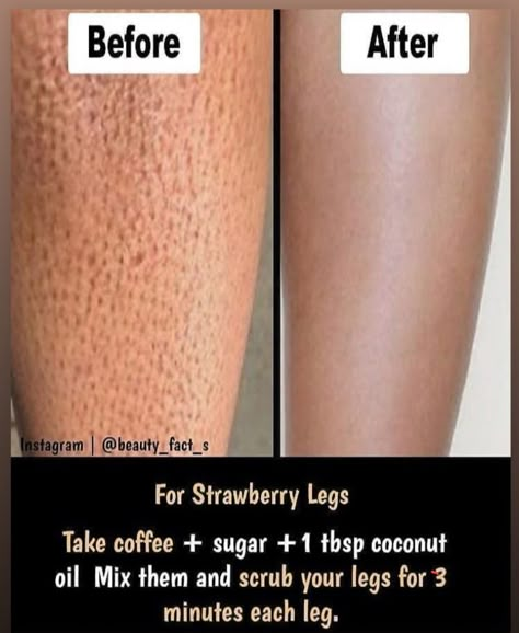 Tips For Glowing Skin, Strawberry Legs, Natural Skin Care Ingredients, Clear Healthy Skin, Natural Skin Care Remedies, Diy Skin Care Routine, Good Skin Tips, Diy Skin Care Recipes, Basic Skin Care Routine