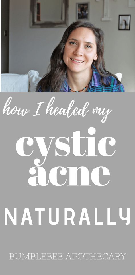 Acne Inflammation Remedies, Bacterial Acne Remedies, Acne Herbal Remedies, Skincare For Cystic Acne, Natural Remedies For Cystic Acne, How To Get Rid Of Cystic Acne Overnight, Heal Acne Fast, What Causes Cystic Acne, Heal Acne Naturally