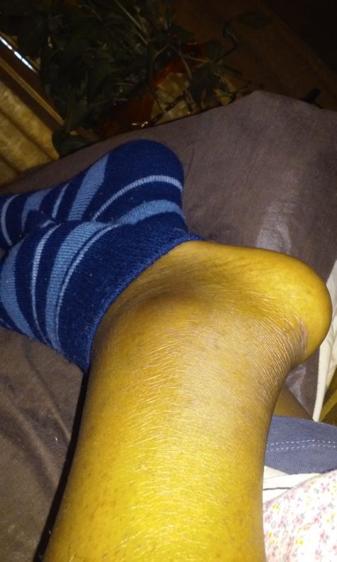 Swollen. looks like a tree trunk.  My first cankle Swollen Legs And Ankles, Strained Ankle, Billie Eilish Sprained Ankle, Broken Ankle Cast, High Ankle Sprain, Swollen Ankles, Broken Foot, Broken Ankle, Swollen Legs