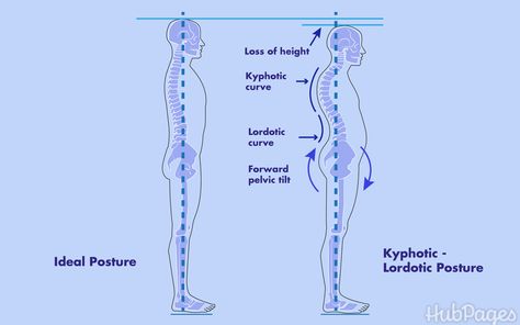 The Importance of Reversal of Cervical and Lumbar Lordosis Cervical Lordosis, Lumbar Lordosis, Neck Posture, Forward Head Posture Exercises, Rare Disease Awareness, Thoracic Vertebrae, Back Ache, Computer Lessons, Forward Head Posture