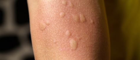 What Causes Hives: When to Worry (Overview and Remedies) Hives Causes, Hives Remedies, Chronic Hives, Medical Help, Health Info, Allergies, No Worries, Medical, Skin