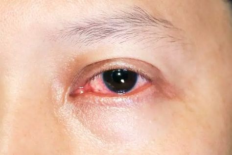 Before heading to the doctor, try one of the many home remedies for red eyes. Redness of the eyes can sometimes be reduced by gently washing them, relaxing Eye Irritation Remedies, Red Eyes Remedy, What Causes Red Eyes, Goopy Eyes, Glassy Eyes, Allergy Eyes, Strained Eyes, Swollen Eyes, Irritated Eye