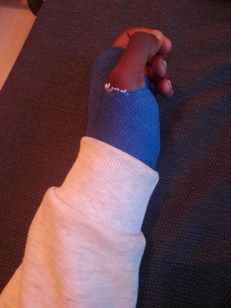 Cvtt1ng Arm, Arm Cast Aesthetic, Broken Arm Cast, Fractured Arm, Broken Finger, Arm Cast, Mixed Boy, Gangsta Quotes, Broken Arm