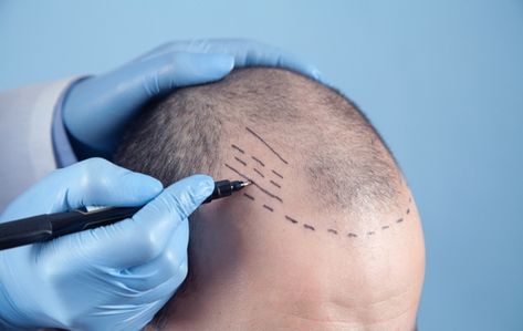 Hair Transplant Myths and Facts: Common Misconceptions Hair Medicine, Hairline Tattoos, Dunner Wordend Haar, Hair Implants, Hair Transplant Cost, Hair Plugs, Hair Transplant Procedure, Scalp Micropigmentation, Fue Hair Transplant