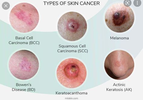 Cancerous Moles, Diseases Pictures, Skin Mapping, Basal Cell, Skin Moles, Squamous Cell, Types Of Skin, Breast Health, Skin Disorders