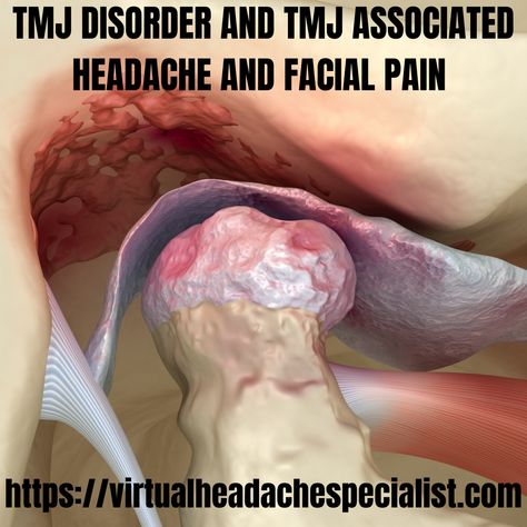 Dislocated Jaw Drawing, Temple Headache Causes, How To Relieve Jaw Tension, Tmj Relief Remedies, Jaw Pain Relief, Tmj Headache, Tmj Relief, Dentistry Humor, Best Exercise For Hips