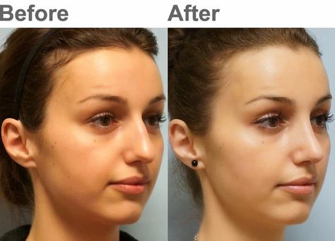 Facial Plastic Surgery: Cosmetic rhinoplasty, Dorsal hump, Tip rotation Dorsal Hump Nose, Hump Nose, Nose Plastic Surgery, Rhinoplasty Nose Jobs, Rhinoplasty Before And After, Facial Surgery, Reduction Surgery, Perfect Nose, Nose Surgery