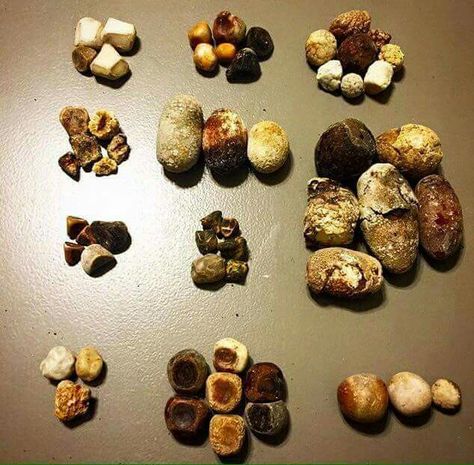 Gall bladder stones, various types, various sizes ... Ayat Mohammed🌸 Bladder Stones, Gall Bladder, Black Peppercorn, Medicine, Condiments