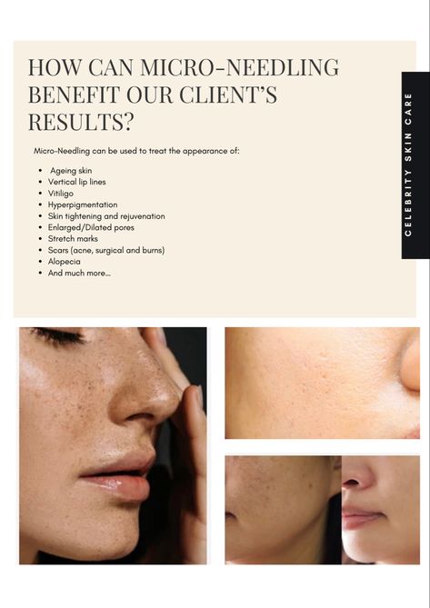 Micro Needling Facial, Micro Needling Benefits, Micro Needling Before And After, Fibroblast Plasma, Aesthetics Business, Beauty School Cosmetology, Esthetician Life, Aesthetic Marketing, Facial Benefits