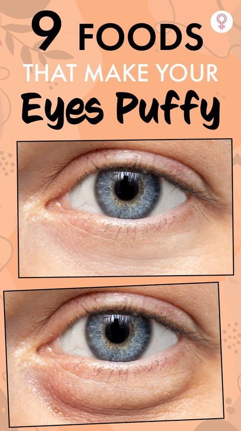 9 Foods That Make Your Eyes Puffy: If you feel like no matter how much water you drink, you just cannot get rid of those pesky puffy eye bags, here are a couple of foods that might be causing them. Consider skipping these food items in your next few meals and see the difference it makes to your skin. #puffyeyes #beauty #beautytips Undereye Bags Remedy, Eye Bag Remedies, Puffy Bags, Puffy Eyes Remedy, Baggy Eyes, Benefits Of Garlic, Puffy Eye, Bags Under Eyes, Swollen Eyes