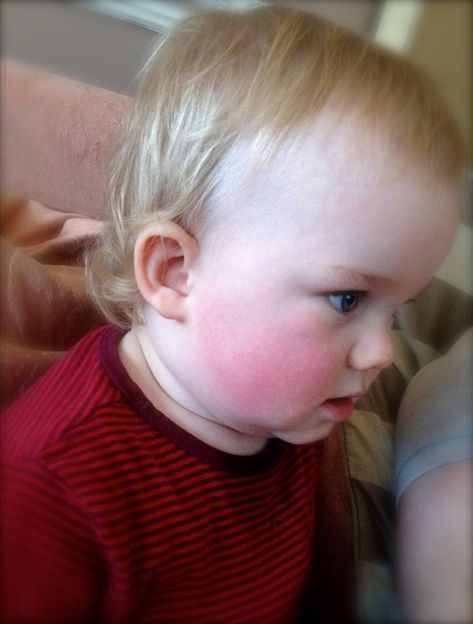 Rosy red cheeks to match his top. Poor little guy! Funny Babies, Red Cheeks, Baby Cheeks, Tummy Ache, Cute Funny Babies, Red Baby, One Of Those Days, Be My Baby, Modest Fashion Outfits