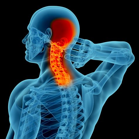 Why neck pain occurs??
Neck pain, or cervicalgia, can last from days to years, depending on the cause. Common causes include physical strain, poor posture, mental stress, osteoarthritis, spinal stenosis, herniated disk, pinched nerve, tumors and other health conditions.
Call us today to discover how we can help you break free from pain and regain your optimal life. Neck Pain Yoga, Forward Head Posture Exercises, Cervical Pain, Neck And Shoulder Muscles, Forward Head Posture, Pinched Nerve, Neck Injury, Head Pain, Pain Relief Cream