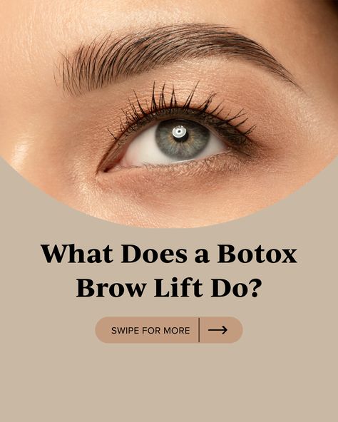 Botox Eyebrow Lift Before And After, Botox Eyebrow Lift, Botox Injection Sites, Allergan Botox, Injection Sites, Muscle Diagram, Botox Injection, Botox Brow Lift, Eyebrow Before And After