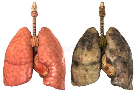 Lungs of a smoker. And healthy lung on white royalty free illustration Lungs Drawing, Human Body Science Projects, Smokers Lungs, Lung Anatomy, Human Body Science, How To Help Nausea, Human Lungs, Constant Headaches, Uses For Vicks