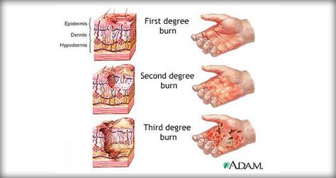 Focus on the major priorities of any trauma patient; the burn wound is a secondary consideration, although aseptic management of the burn wounds and invasive lines continues. Burns Nursing, Burn Injury, Degree Burns, Cooking Pasta, Nursing Care Plan, Effects Makeup, Natural Collagen, Laser Therapy, Nursing Care