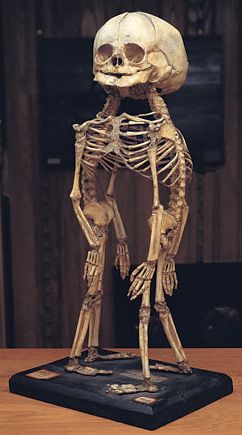 Aww God bless it!!! Cephalothoracopagus. Skeleton of conjoined twins. Human Oddities, Conjoined Twins, A Skeleton, Six Feet Under, 판타지 아트, 영감을 주는 캐릭터, Weird And Wonderful, Skull And Bones, Archaeology