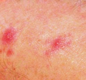 Identify Bug Bites - Common Bug Bites | Orkin Insect Bites Identification, Bug Bites Identifying Chart, Bug Bites Identifying, Infected Bug Bite, Red Bug Bites, Bed Bug Bites Pictures, Dust Mites Bites, Types Of Bug Bites, Spider Bites Pictures