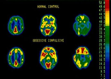 Pet Scan Image, Ocd Brain, Types Of Ocd, Brain Nervous System, Pet Scan, Brain Scan, Mental Health Facts, Medical Anatomy, Color Collage