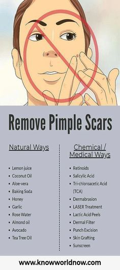 How To Get Rid Of A Pimple Scar, Tips For Pimples How To Remove, How To Remove Acne Scaring, Pimple Scar Removal, How To Avoid Pimples Tips Clear Skin, To Remove Pimples, Tea Tree Oil Skin, Pimples Remove Tips For Girl, Remove Pimples