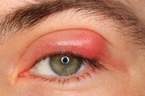 Sty In Eye Remedies, Get Rid Of Stye, Stye Remedy, Eye Stye Remedies, Natural Headache Remedies, Healthy Eyes, Natural Health Remedies, Eye Health, Health And Beauty Tips