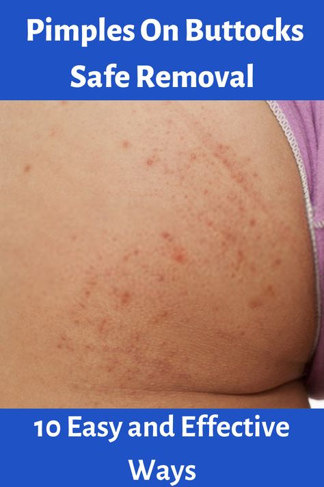 Pimples On Buttocks Safe Removal - 10 Easy and Effective Ways How To Get Rid Of Bumps On Buttocks, How To Get Rid Of Buttocks Acne Quick, How To Get Rid Of Buttocks Acne, Leg Pimples, Bumps On Legs, Buttocks Acne, How To Treat Pimples, What Causes Pimples, Blackheads On Cheeks