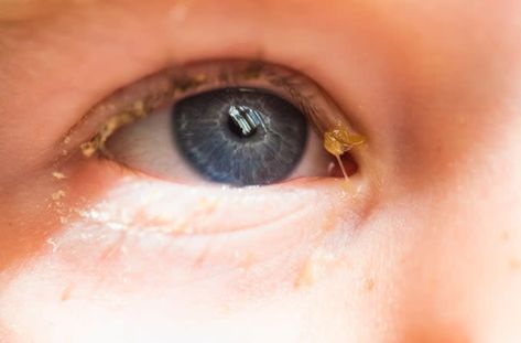 Crusty Eyes Remedies, Newborn Eye Discharge, Watery Eyes Remedy, Eye Infection Remedies, Goopy Eyes, Crusty Eyes, Pinkeye Remedies, Allergy Eyes, Homeopathy Remedies