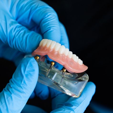 Discover the superior quality of All-on-4 dental implants crafted in our state-of-the-art dental lab! Your patients can enjoy unmatched stability, functionality, and aesthetics, all while benefiting from the precision and care of our dedicated dental technicians.   #ReliableDentalLab #DentalLab #DentalImplants #AllOnFour #FullArch Dental Fillings, Dental Technician, Dental Emergency, Dental Laboratory, Emergency Dentist, Dental School, Dental Cosmetics, Dental Procedures, Dental Lab